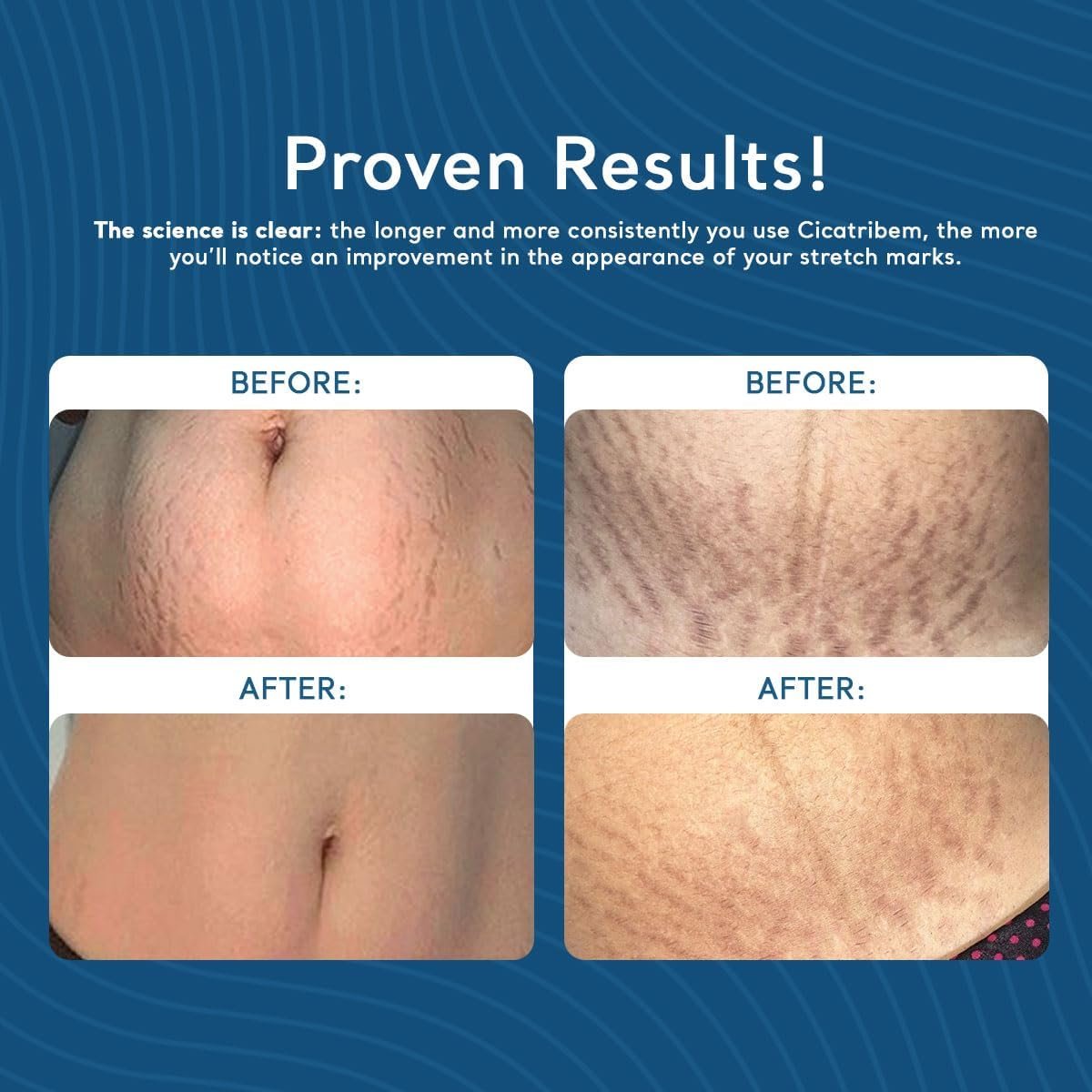 Creme para Estrias Cicatribem 150g - Image 2